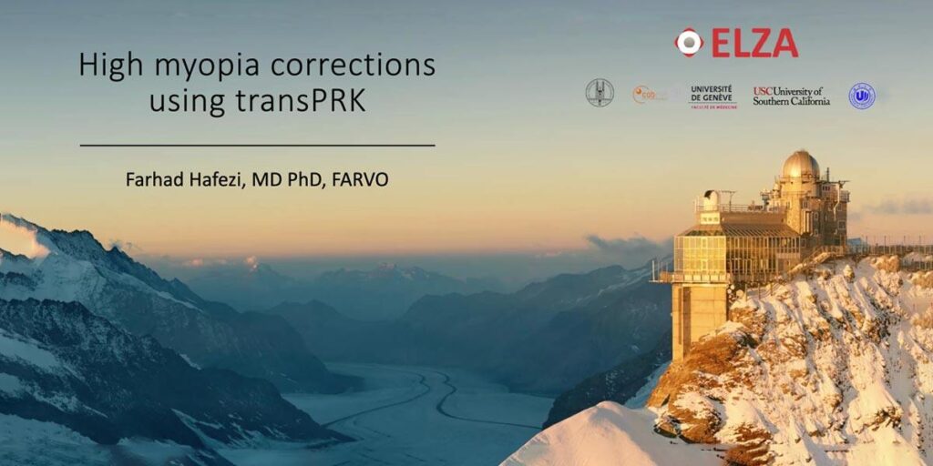 High myopia corrections using transPRK featured image