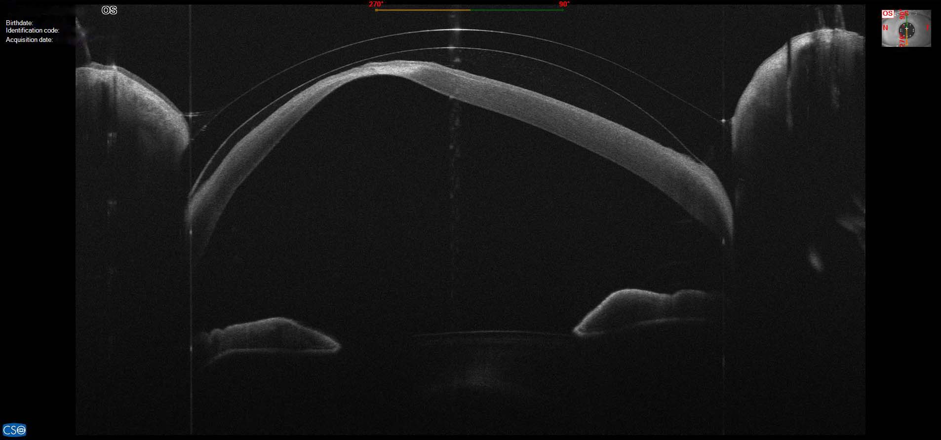 Customized Scleral Lenses for Keratoconus The ELZA Institute