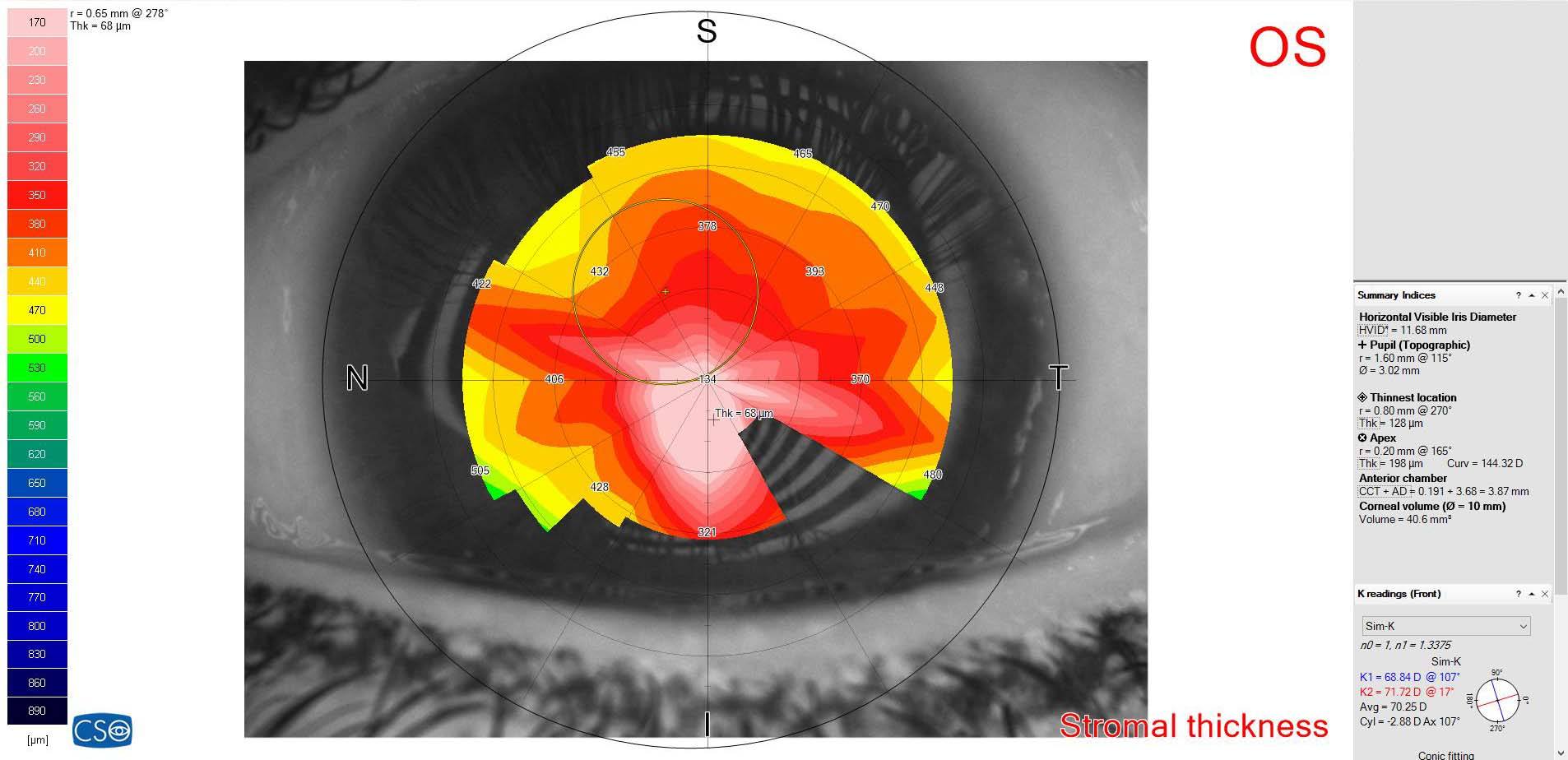 Customized Scleral Lenses for Keratoconus The ELZA Institute