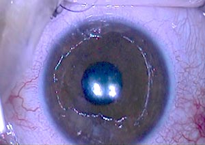 cxl-in-den-usa-entferntes-epithel-wikipedia