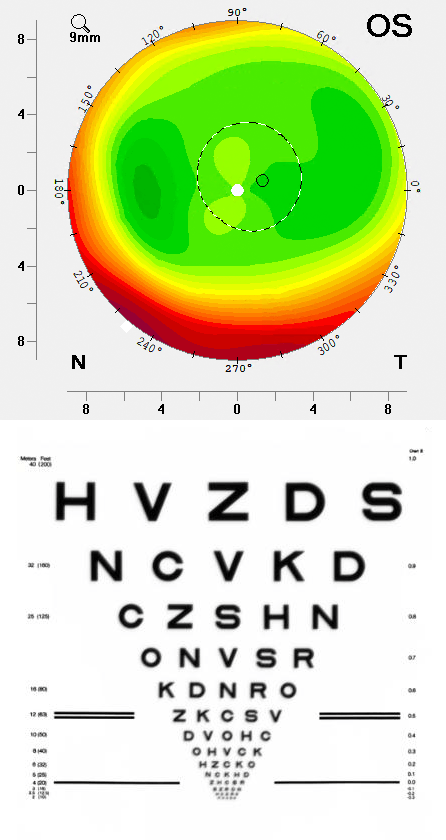 Die Sicht nach einer alten Laser-Korrektur verbessern