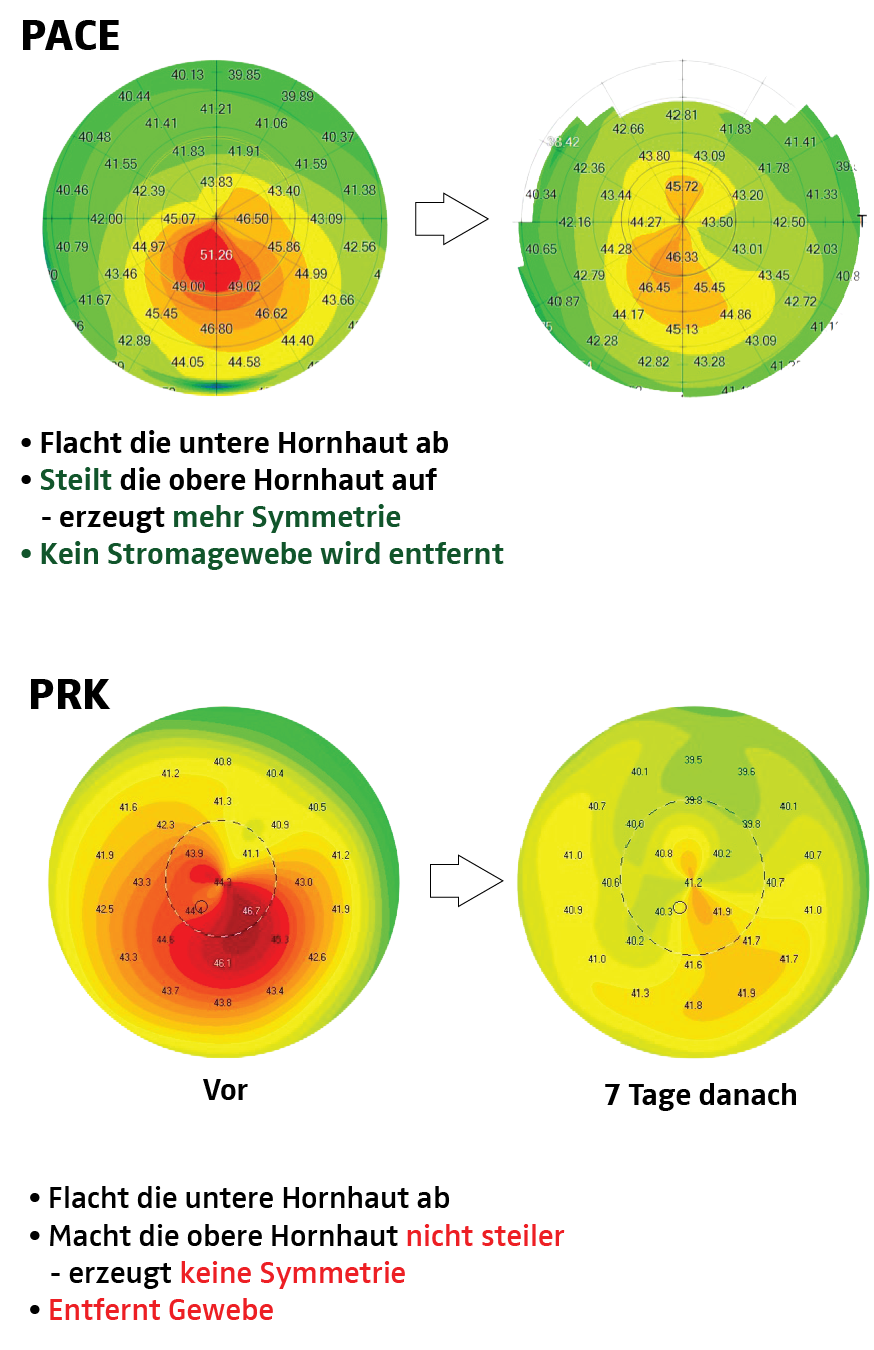 Vor und nach PACE; beachten Sie die symmetrische Hornhauttopographie, die die Sehschärfe erheblich verbessert