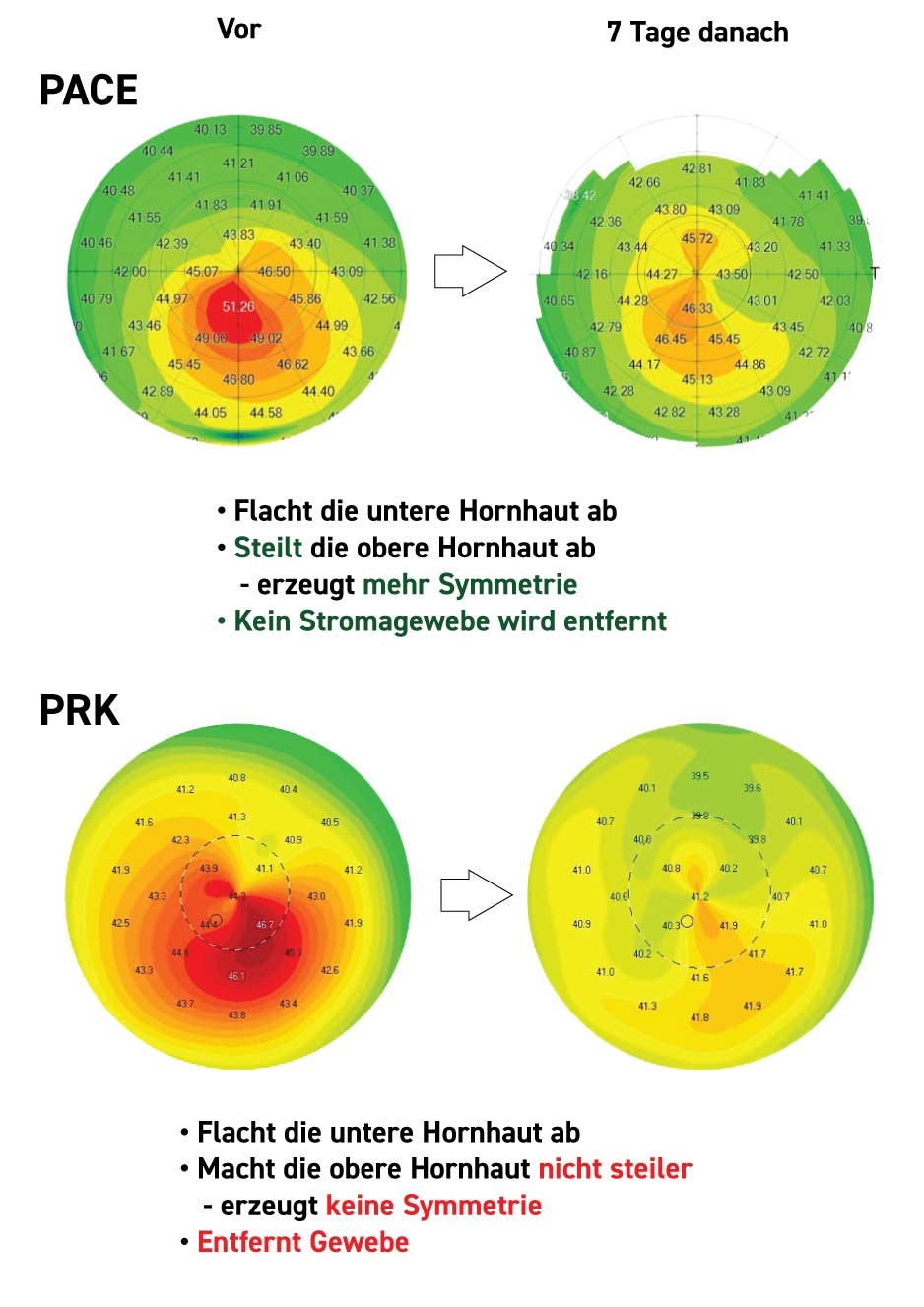 Individuelles Hornhaut-Crosslinking mit PACE