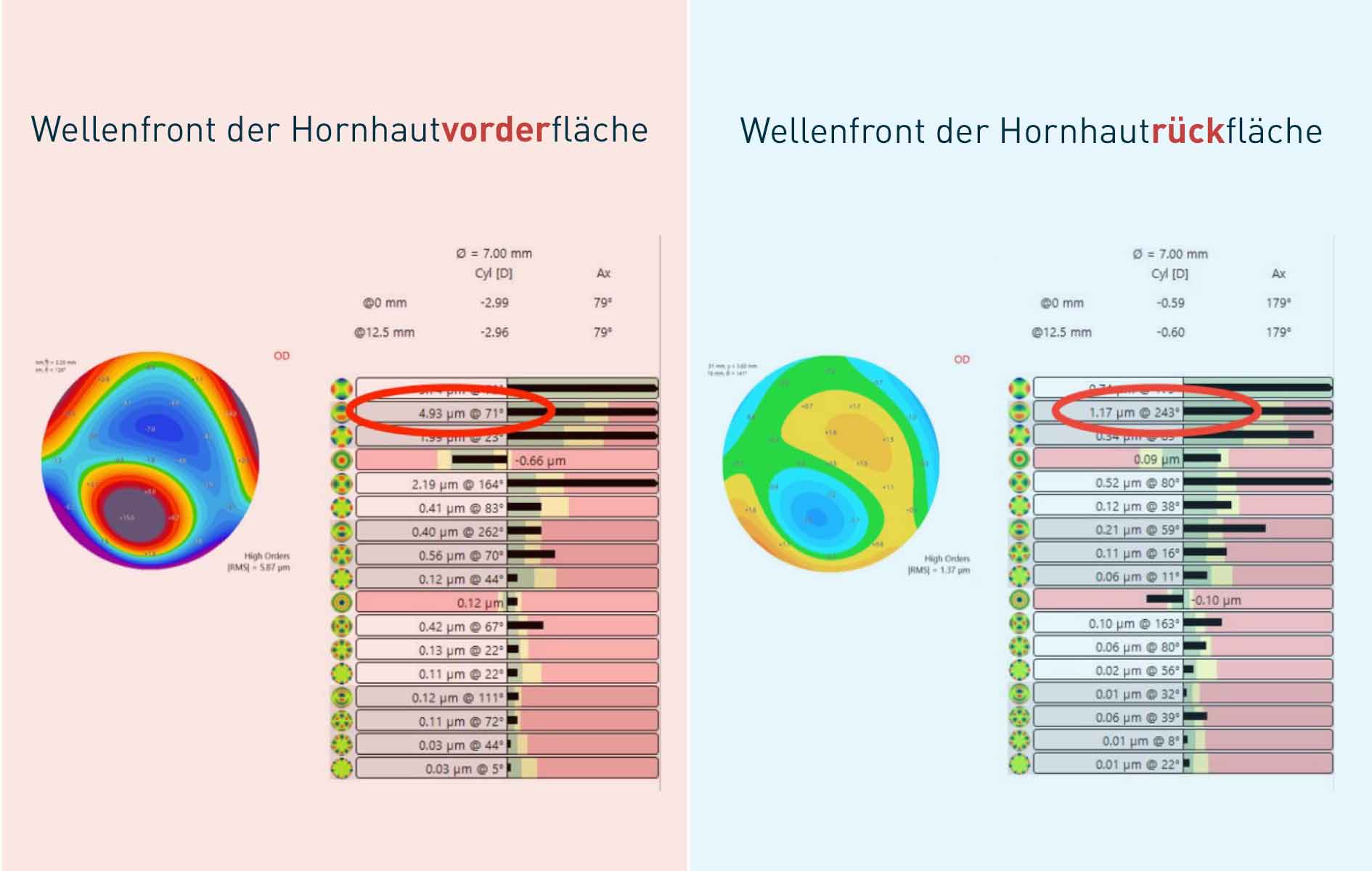 Alt Text: Einfluss der hinteren Hornhautoberfläche - Visuelle Darstellung, die zeigt, wie die hintere Hornhautoberfläche in Verbindung mit anderen internen Faktoren zu Aberrationen hoher Ordnung im optischen System des Auges beiträgt