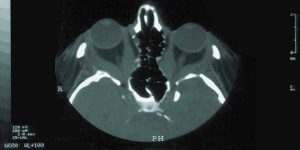 Hervortretende Augen Basedowsche Krankheit Chirurgie