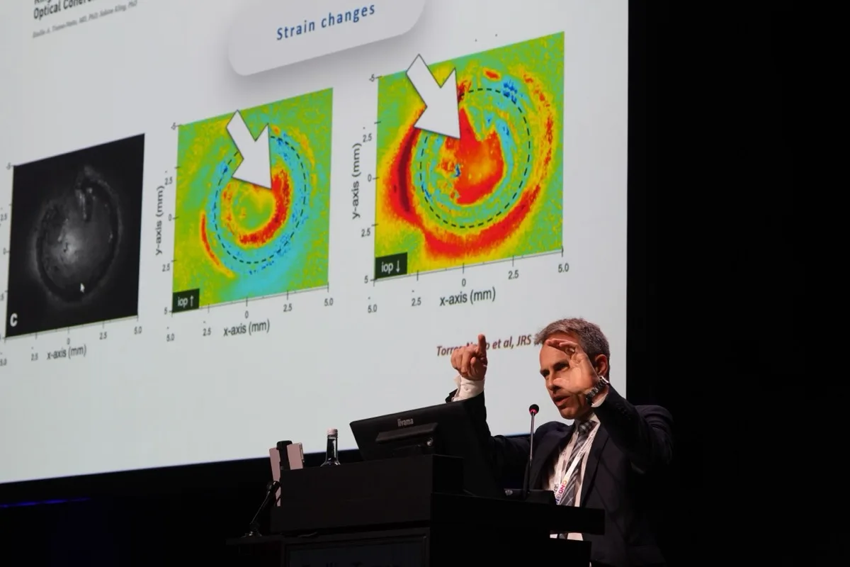 Emilio Torres-Netto presenting ECO-CAIRS at ESCRS 2026