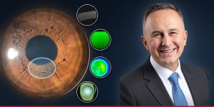 Prof. Farhad Hafezi beside an iris and images from four cross-linking protocols for keratoconus